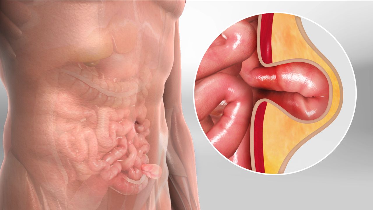 Laparoscopic hernia repair surgery at Suvira Hospital